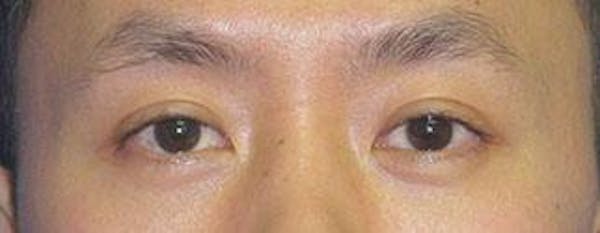 Asian Eyelid Surgery Before & After Gallery - Patient 25274770 - Image 2