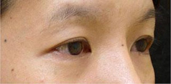 Asian Eyelid Surgery Before & After Gallery - Patient 25274771 - Image 1