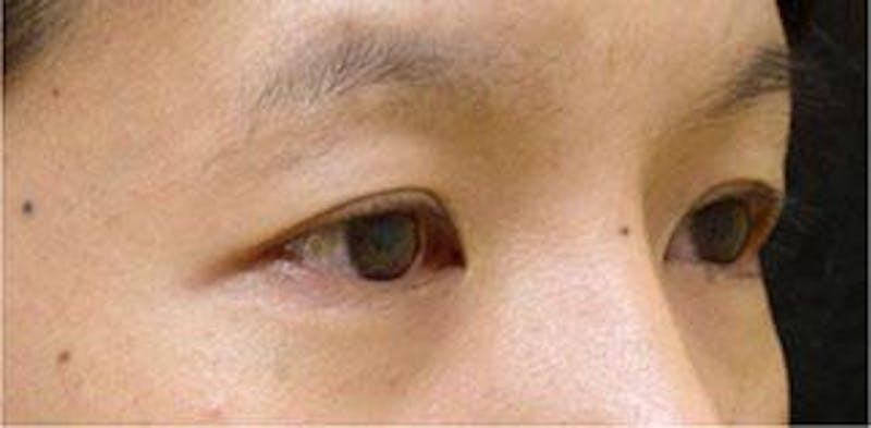Asian Eyelid Surgery Before & After Gallery - Patient 25274771 - Image 1