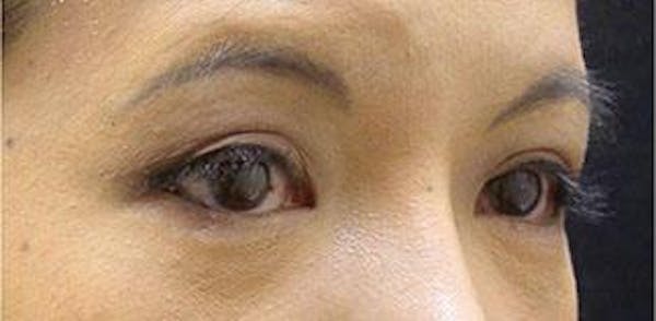 Asian Eyelid Surgery Before & After Gallery - Patient 25274771 - Image 2