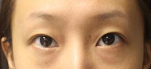 Asian Eyelid Surgery Before & After Gallery - Patient 25274773 - Image 1