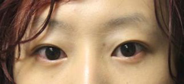Asian Eyelid Surgery Before & After Gallery - Patient 25274773 - Image 2