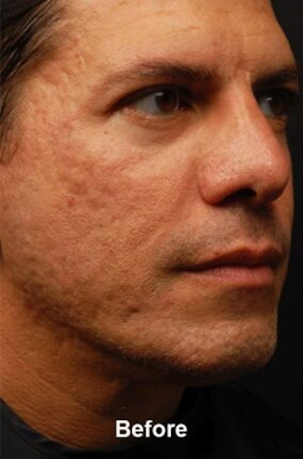 Microneedling Before & After Gallery - Patient 25274779 - Image 1