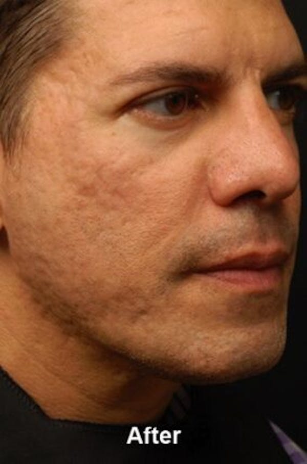 Microneedling Before & After Gallery - Patient 25274779 - Image 2