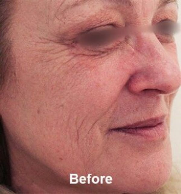Microneedling Before & After Gallery - Patient 25274784 - Image 1