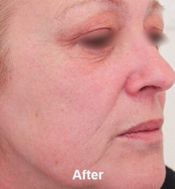 Microneedling Before & After Gallery - Patient 25274784 - Image 2