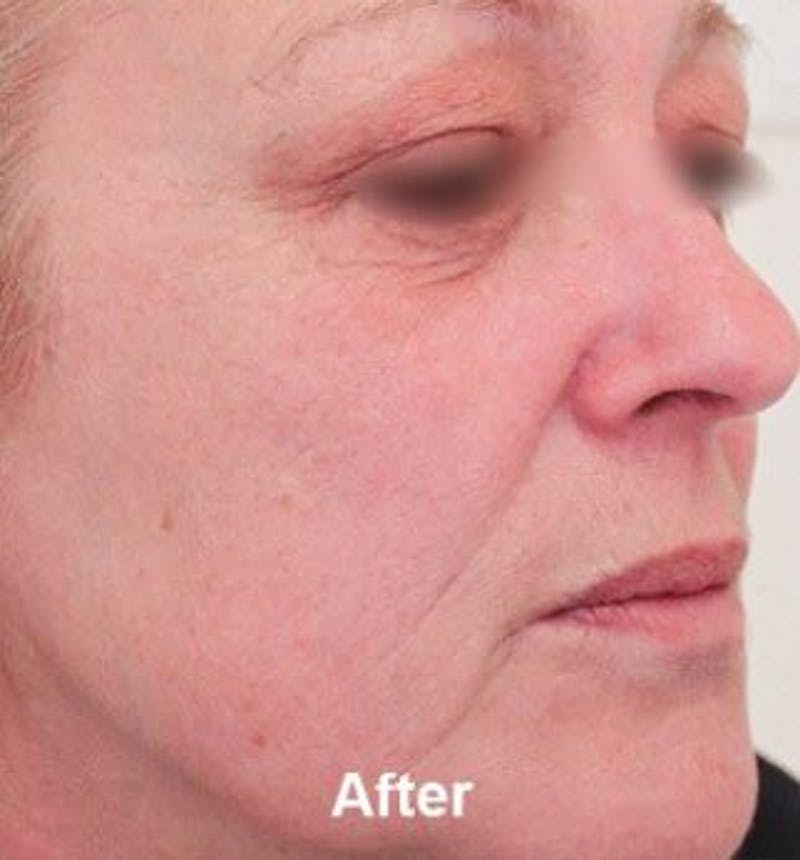 Microneedling Before & After Gallery - Patient 25274784 - Image 2