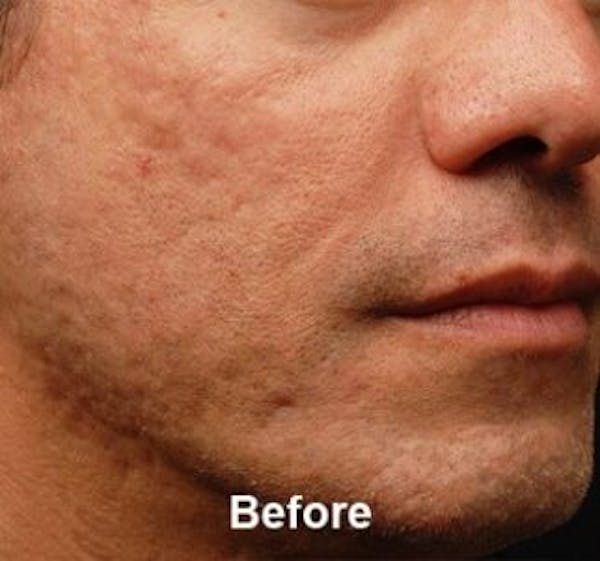 Microneedling Before & After Gallery - Patient 25274807 - Image 1