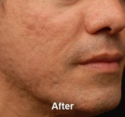 Microneedling Before & After Gallery - Patient 25274807 - Image 2