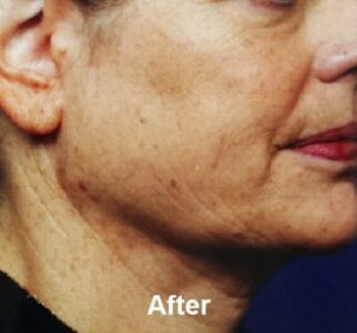 Microneedling Before & After Gallery - Patient 25274808 - Image 2