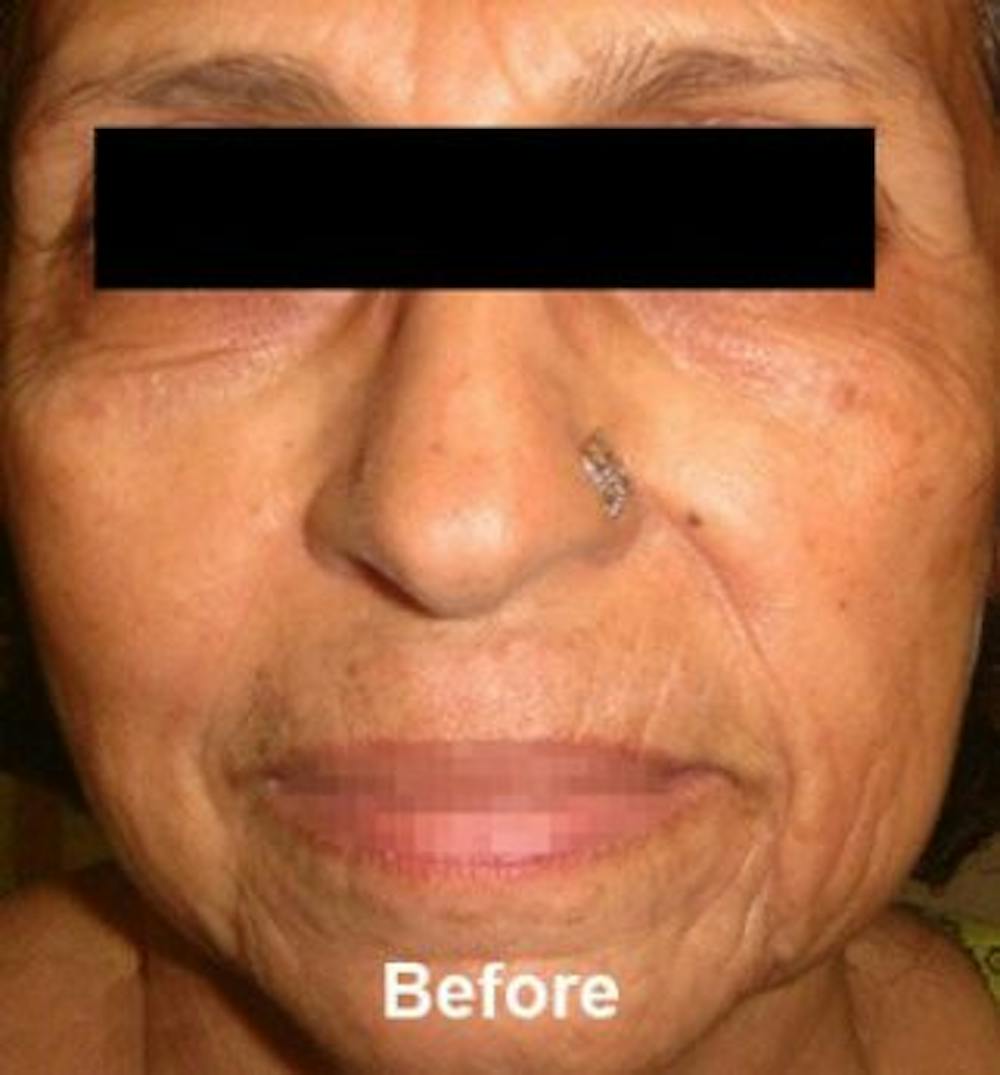 Microneedling Before & After Gallery - Patient 25274826 - Image 1