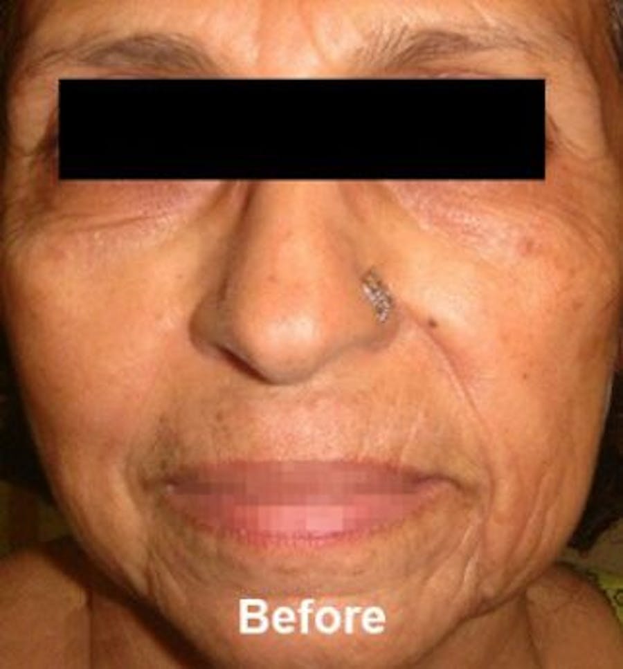 Microneedling Before & After Gallery - Patient 25274826 - Image 1