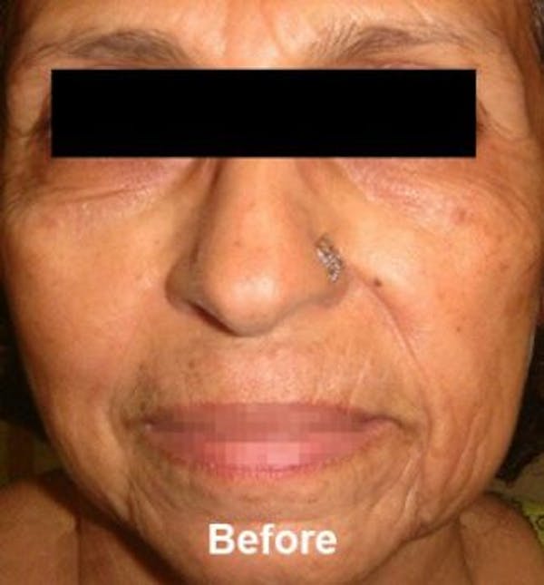 Microneedling Before & After Gallery - Patient 25274826 - Image 1