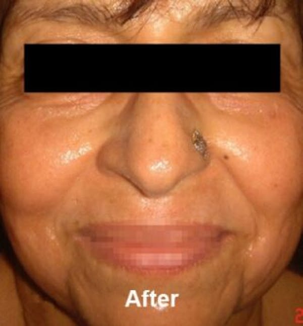 Infini Before & After Gallery - Patient 25274826 - Image 2