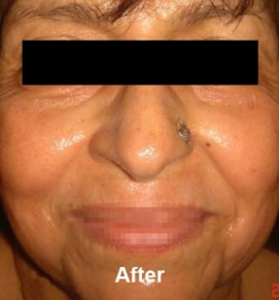 Microneedling Before & After Gallery - Patient 25274826 - Image 2