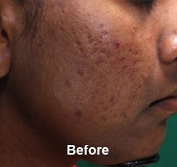 Microneedling Before & After Gallery - Patient 25274828 - Image 1