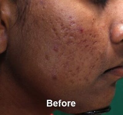 Microneedling Before & After Gallery - Patient 25274828 - Image 1
