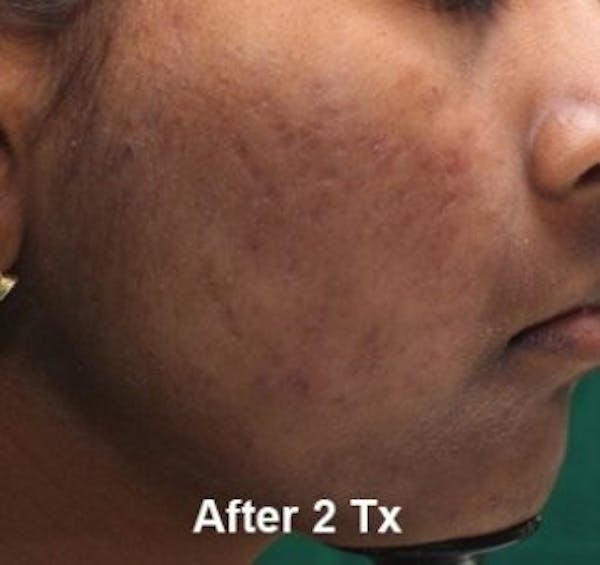 Microneedling Before & After Gallery - Patient 25274828 - Image 2