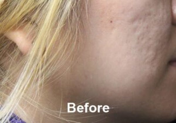 Microneedling Before & After Gallery - Patient 25274830 - Image 1