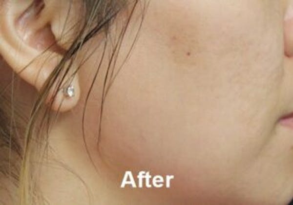 Microneedling Before & After Gallery - Patient 25274830 - Image 2