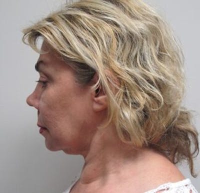 Thermirf Before & After Gallery - Patient 25274832 - Image 1
