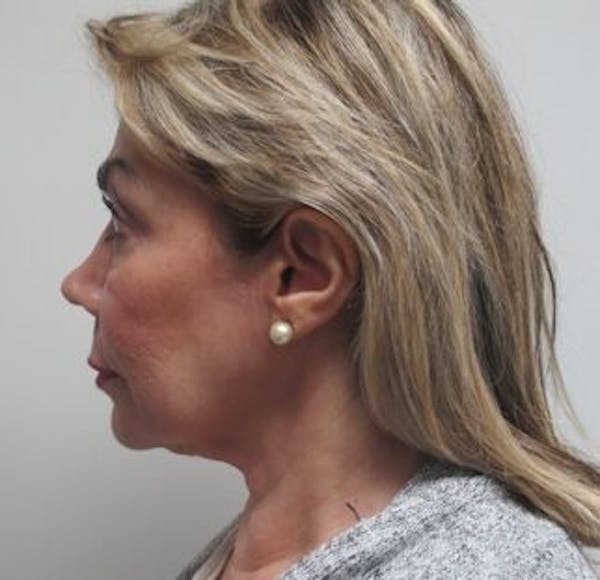 Thermirf Before & After Gallery - Patient 25274832 - Image 2