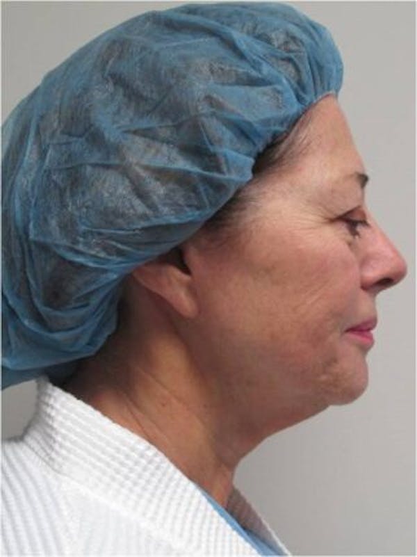Thermirf Before & After Gallery - Patient 25274846 - Image 1