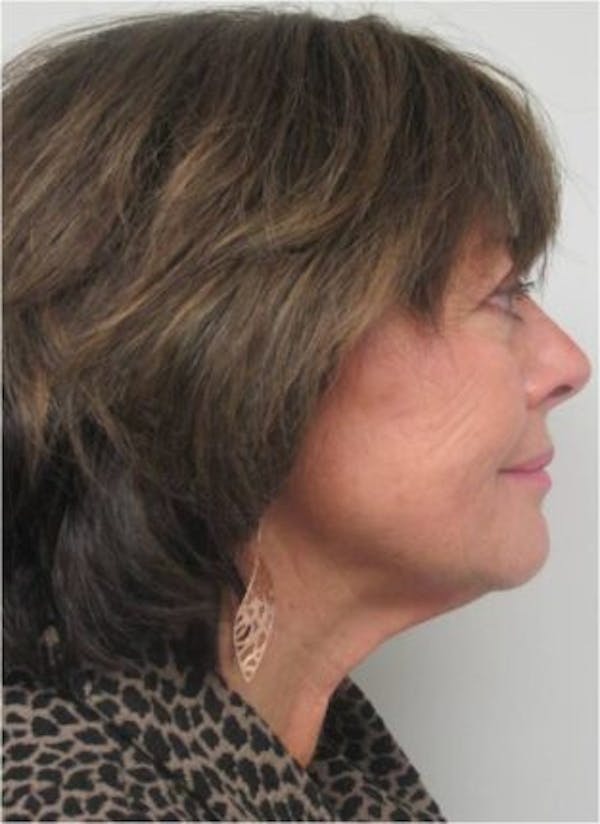 Thermirf Before & After Gallery - Patient 25274846 - Image 2