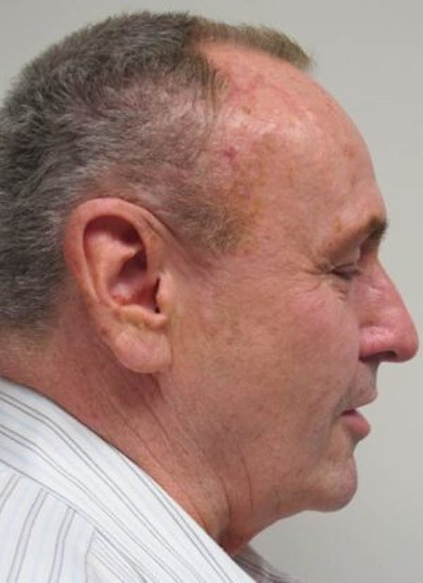 Thermirf Before & After Gallery - Patient 25274847 - Image 1