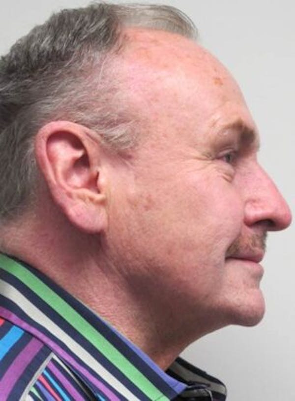 Thermirf Before & After Gallery - Patient 25274847 - Image 2