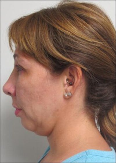 Thermirf Before & After Gallery - Patient 25274848 - Image 1