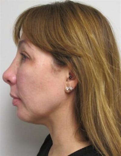 Thermirf Before & After Gallery - Patient 25274848 - Image 2
