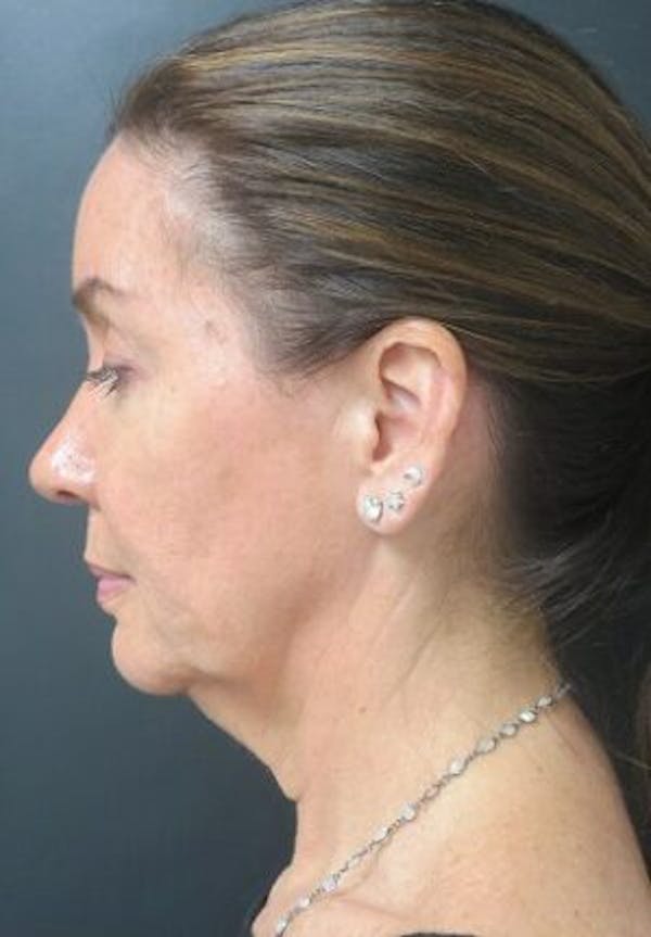 Thermirf Before & After Gallery - Patient 25274851 - Image 1
