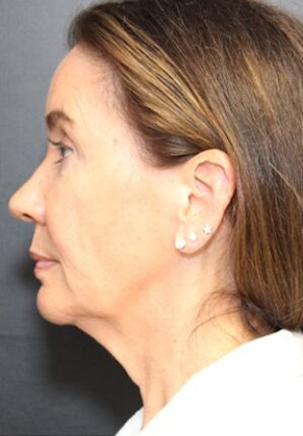 Thermirf Before & After Gallery - Patient 25274851 - Image 2