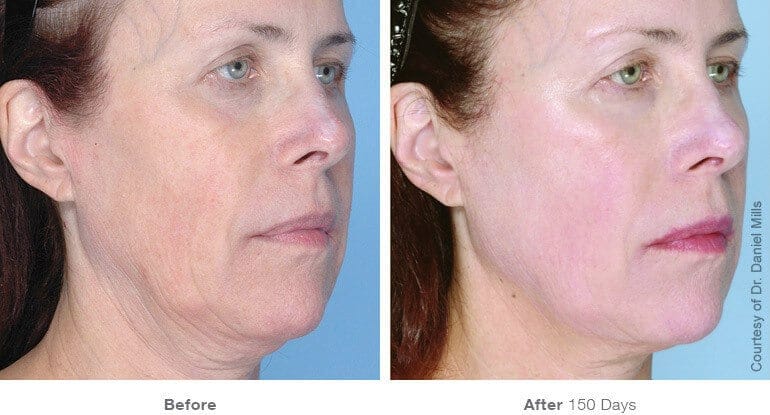 ultherapy before after