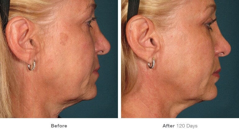 ultherapy before after