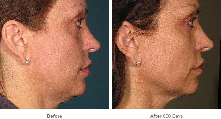 ultherapy before after