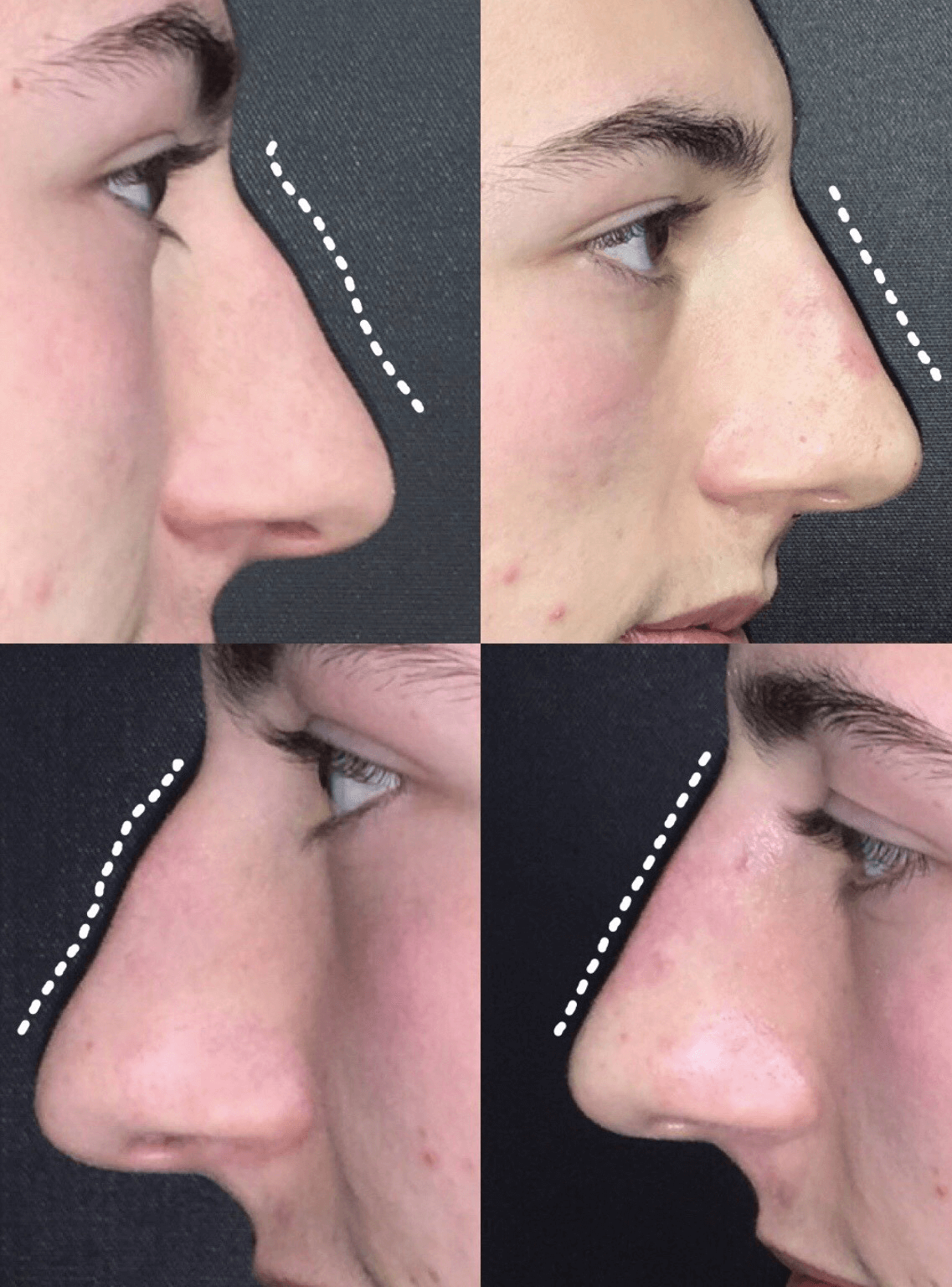 NYC non-surgical rhinoplasty before and after photo