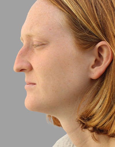 Before & After Rhinoplasty in NYC