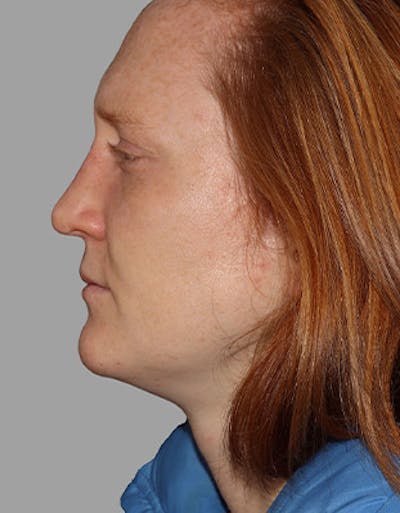 Before & After Rhinoplasty in NYC