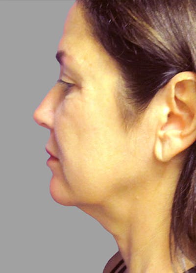 Facelift Before & After Gallery - Patient 31914197 - Image 1