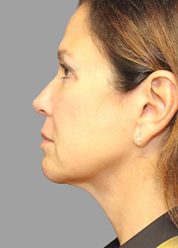 Necklift Before & After Gallery - Patient 121745316 - Image 4