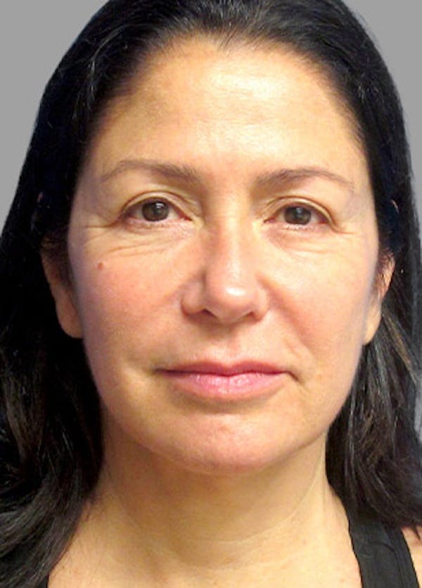 Necklift Before & After Gallery - Patient 121745316 - Image 1