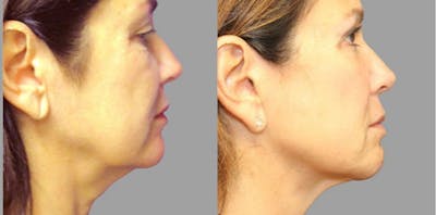 Facelift Before & After Gallery - Patient 54030910 - Image 1