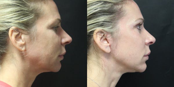 Facelift Before & After Gallery - Patient 54030911 - Image 1