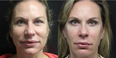 Facelift Before & After Gallery - Patient 54030911 - Image 2