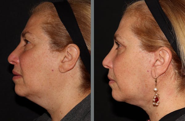 Facelift Before & After Gallery - Patient 54030912 - Image 2