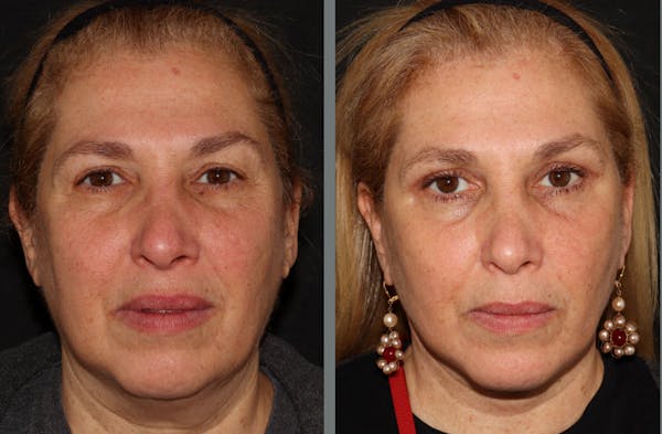 Facelift Before & After Gallery - Patient 54030912 - Image 1