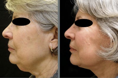 Facelift Before & After Gallery - Patient 54030913 - Image 1