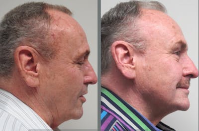 Facelift Before & After Gallery - Patient 54030914 - Image 1